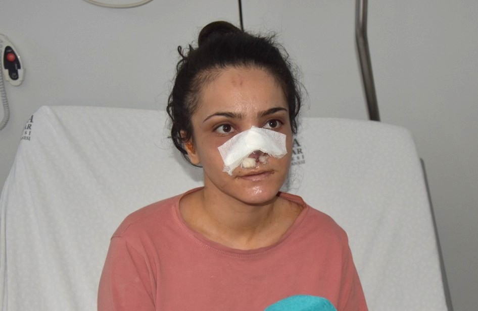 Manisa’nın Turgutlu ilçesinde eşi tarafından darbedilip burnu ısırılarak koparılan 28